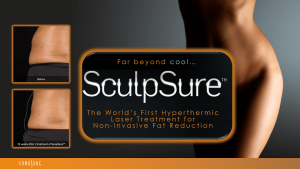 sculpsure