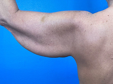 Brachioplasty Before and After | Plastic Surgery Associates of Valdosta