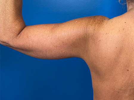 Brachioplasty Before and After | Plastic Surgery Associates of Valdosta