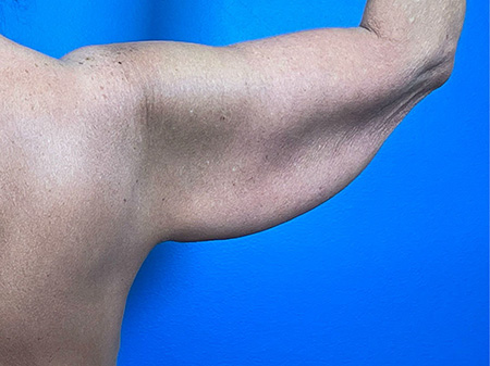 Brachioplasty Before and After | Plastic Surgery Associates of Valdosta