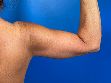 Brachioplasty Before and After | Plastic Surgery Associates of Valdosta