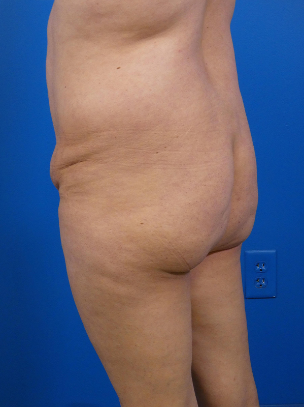 Brazilian Butt Lift Before and After | Plastic Surgery Associates of Valdosta