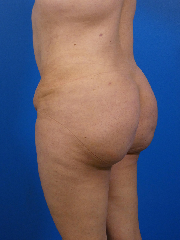 Brazilian Butt Lift Before and After | Plastic Surgery Associates of Valdosta