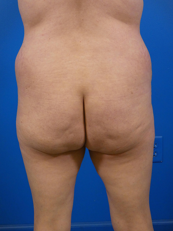 Brazilian Butt Lift Before and After | Plastic Surgery Associates of Valdosta