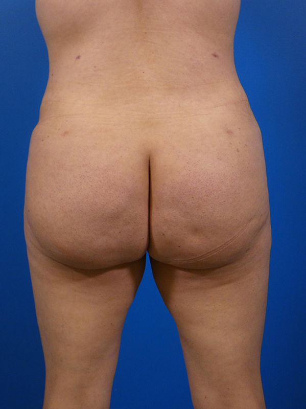 Brazilian Butt Lift Before and After | Plastic Surgery Associates of Valdosta