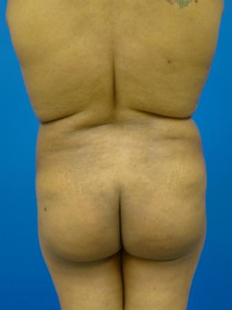 Brazilian Butt Lift Before and After | Plastic Surgery Associates of Valdosta