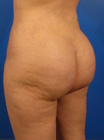 Brazilian Butt Lift Before and After | Plastic Surgery Associates of Valdosta