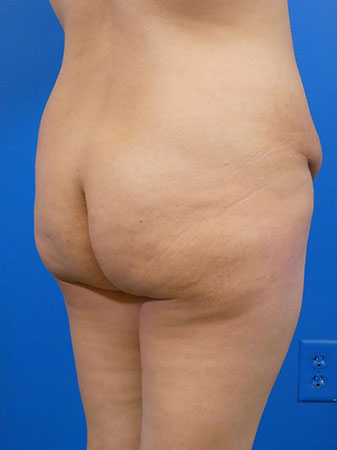 Brazilian Butt Lift Before and After | Plastic Surgery Associates of Valdosta