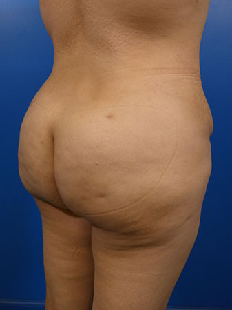 Brazilian Butt Lift Before and After | Plastic Surgery Associates of Valdosta