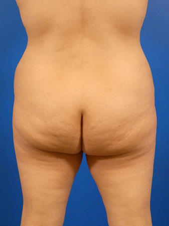 Brazilian Butt Lift Before and After | Plastic Surgery Associates of Valdosta