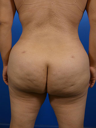 Brazilian Butt Lift Before and After | Plastic Surgery Associates of Valdosta