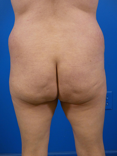 Brazilian Butt Lift Before and After | Plastic Surgery Associates of Valdosta