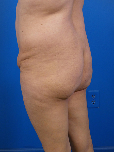 Brazilian Butt Lift Before and After | Plastic Surgery Associates of Valdosta