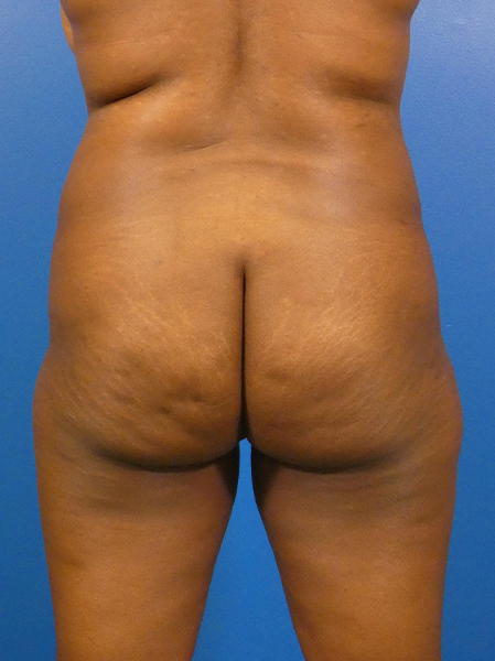 Brazilian Butt Lift Before and After | Plastic Surgery Associates of Valdosta