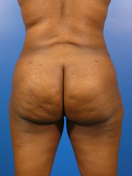 Brazilian Butt Lift Before and After | Plastic Surgery Associates of Valdosta