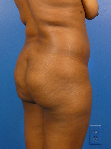 Brazilian Butt Lift Before and After | Plastic Surgery Associates of Valdosta