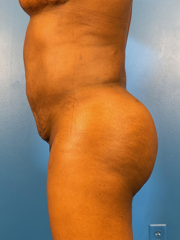 Brazilian Butt Lift Before and After | Plastic Surgery Associates of Valdosta