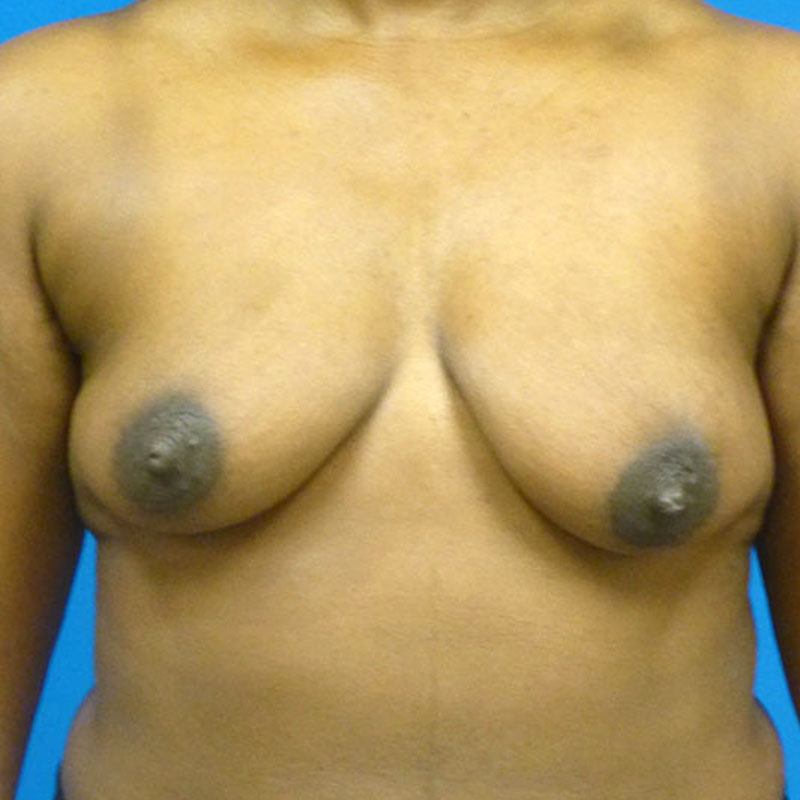 Breast Augmentation With Lift Before and After | Plastic Surgery Associates of Valdosta