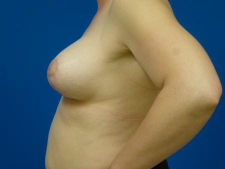 Breast Augmentation With Lift Before and After | Plastic Surgery Associates of Valdosta