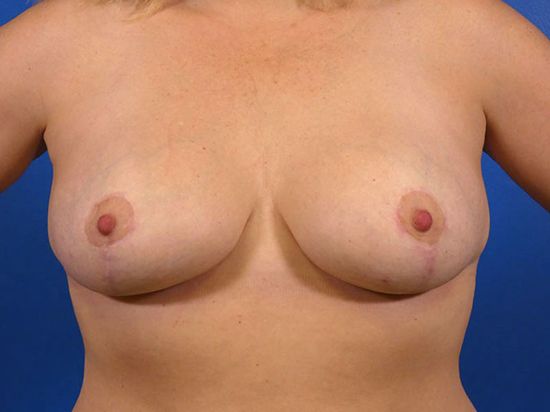 Breast Augmentation With Lift Before and After | Plastic Surgery Associates of Valdosta