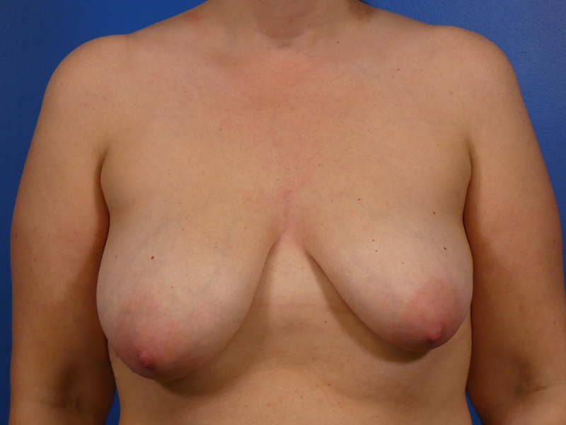 Breast Augmentation With Lift Before and After | Plastic Surgery Associates of Valdosta