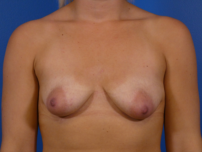 Breast Augmentation With Lift Before and After | Plastic Surgery Associates of Valdosta