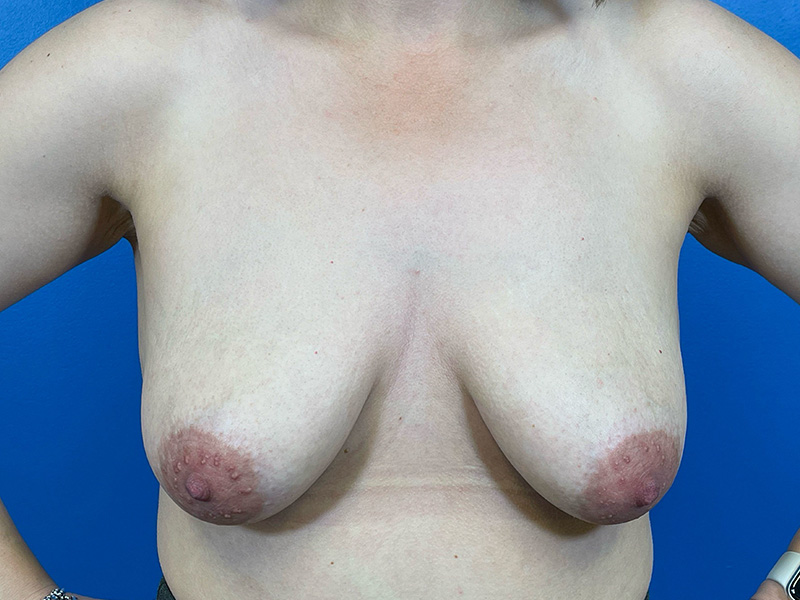Breast Augmentation With Lift Before and After | Plastic Surgery Associates of Valdosta
