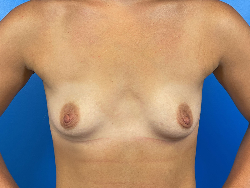 Breast Augmentation Before and After | Plastic Surgery Associates of Valdosta