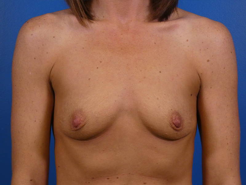 Breast Augmentation Before and After | Plastic Surgery Associates of Valdosta