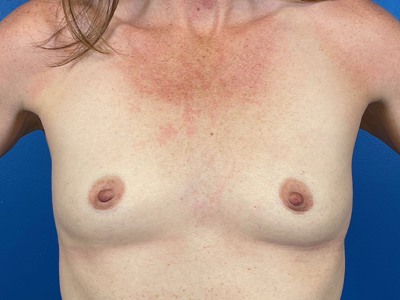 Breast Augmentation Before and After | Plastic Surgery Associates of Valdosta