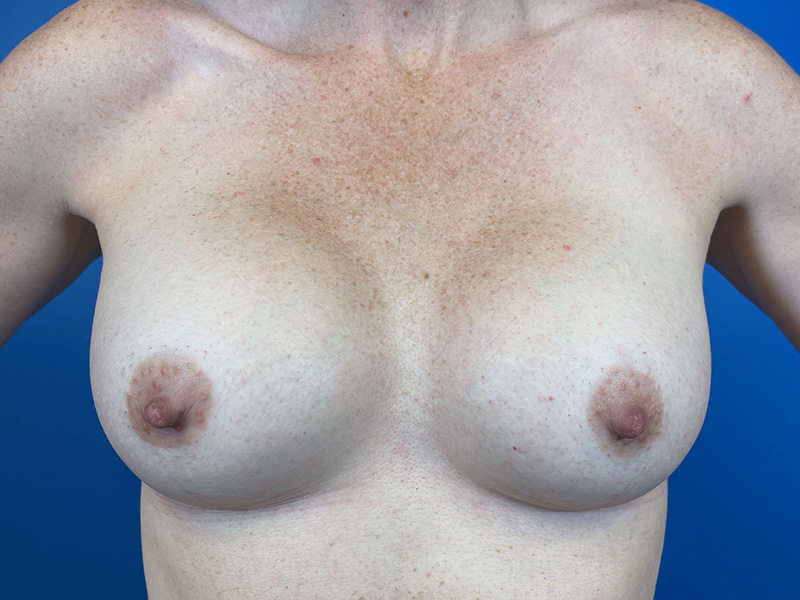 Breast Augmentation Before and After | Plastic Surgery Associates of Valdosta