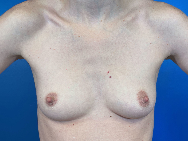 Breast Augmentation Before and After | Plastic Surgery Associates of Valdosta