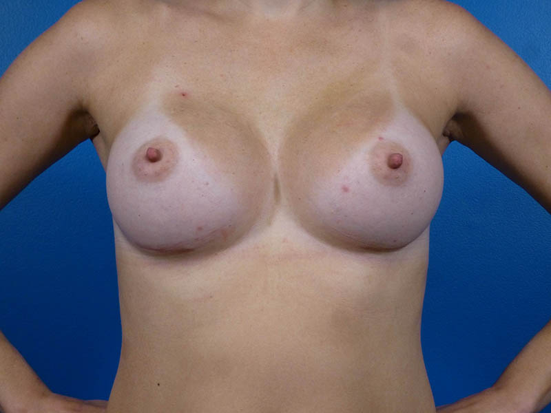 Breast Augmentation Before and After | Plastic Surgery Associates of Valdosta