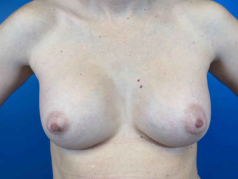 Breast Augmentation Before and After | Plastic Surgery Associates of Valdosta