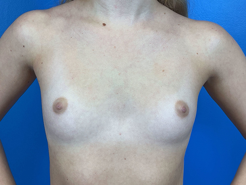 Breast Augmentation Before and After | Plastic Surgery Associates of Valdosta