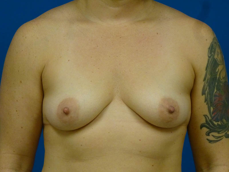 Breast Augmentation Before and After | Plastic Surgery Associates of Valdosta