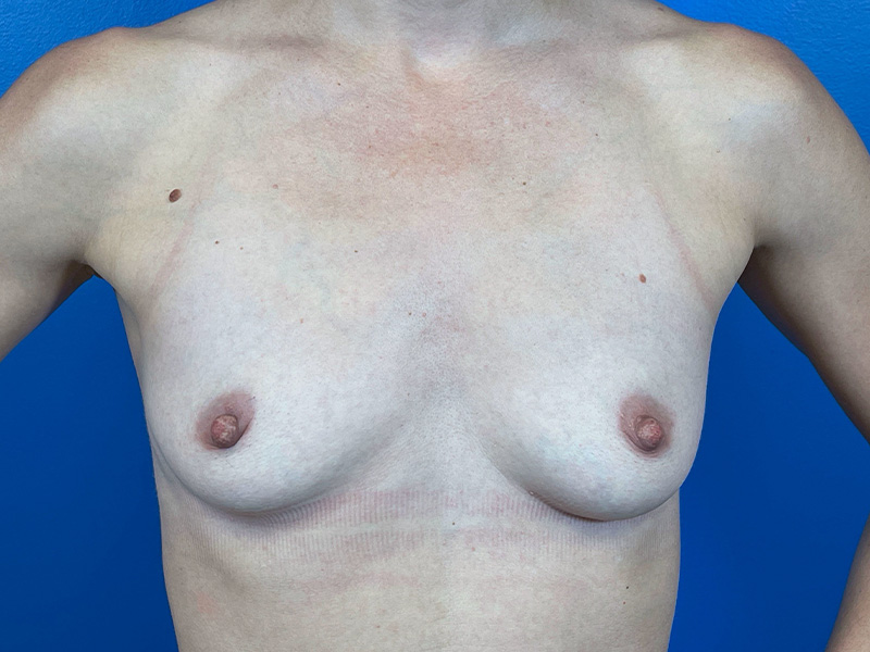 Breast Augmentation Before and After | Plastic Surgery Associates of Valdosta