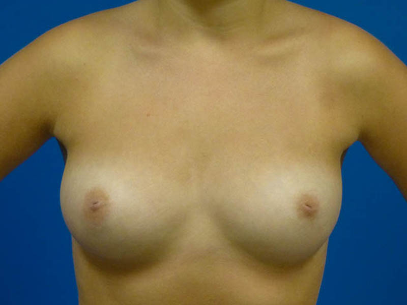 Breast Augmentation Before and After | Plastic Surgery Associates of Valdosta