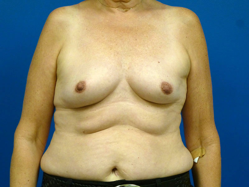 Breast Augmentation Before and After | Plastic Surgery Associates of Valdosta