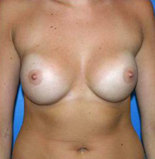 Breast Augmentation Before and After | Plastic Surgery Associates of Valdosta