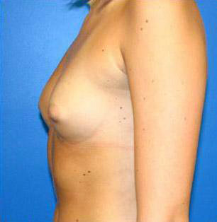 Breast Augmentation Before and After | Plastic Surgery Associates of Valdosta