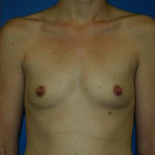 Breast Augmentation Before and After | Plastic Surgery Associates of Valdosta