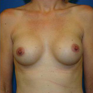 Breast Augmentation Before and After | Plastic Surgery Associates of Valdosta