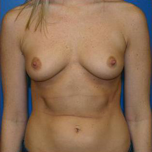 Breast Augmentation Before and After | Plastic Surgery Associates of Valdosta