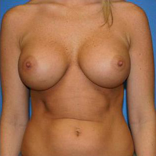 Breast Augmentation Before and After | Plastic Surgery Associates of Valdosta