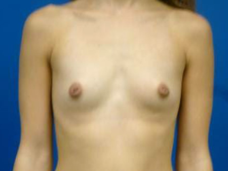 Breast Augmentation Before and After | Plastic Surgery Associates of Valdosta