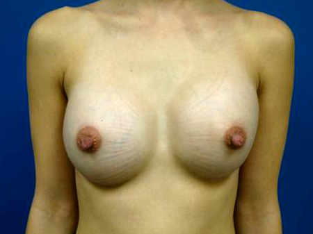 Breast Augmentation Before and After | Plastic Surgery Associates of Valdosta