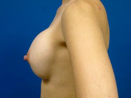 Breast Augmentation Before and After | Plastic Surgery Associates of Valdosta