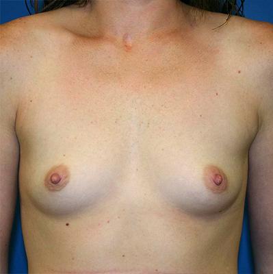 Breast Augmentation Before and After | Plastic Surgery Associates of Valdosta