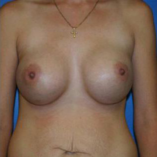 Breast Augmentation Before and After | Plastic Surgery Associates of Valdosta